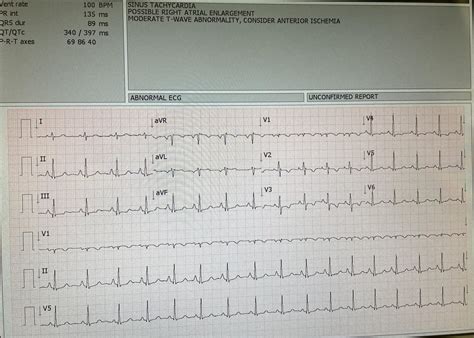 I had a ekg and it said it was abnormal because of a left axis .